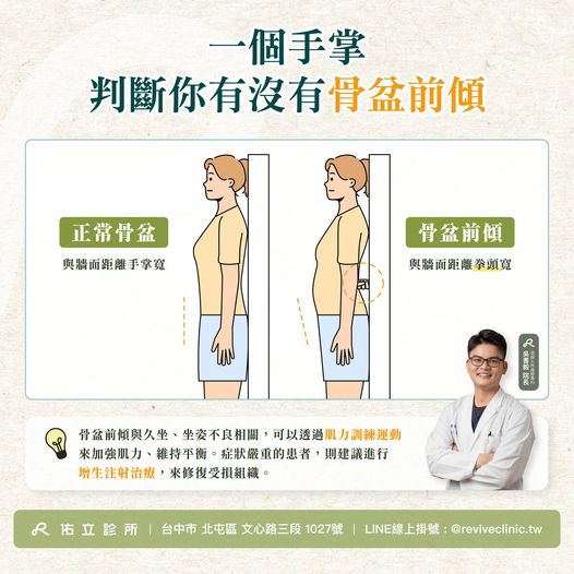 一個手掌判斷你有沒有骨盆前傾？認識骨盆前傾的成因、症狀與治療 -佑立診所 Revive Clinic