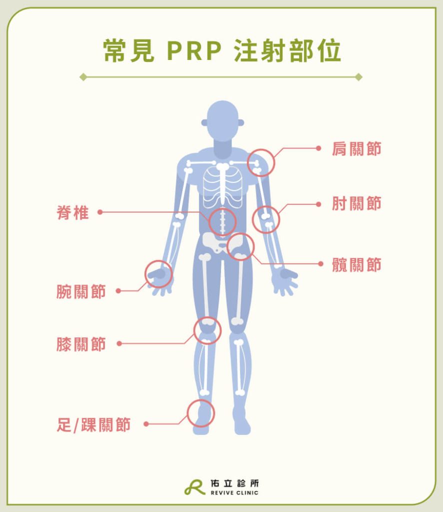 常見 PRP 注射部位