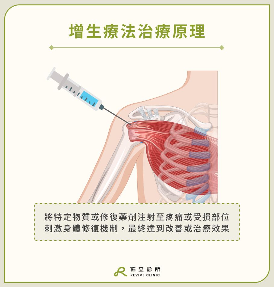 增生療法治療原理