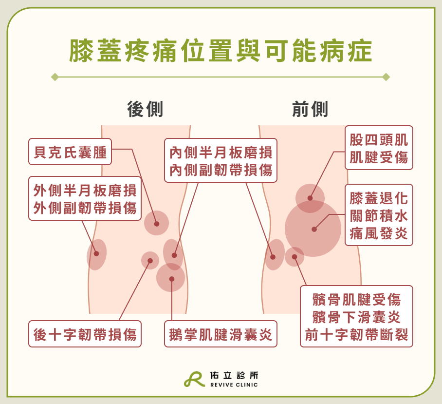 膝蓋疼痛位置與可能病症